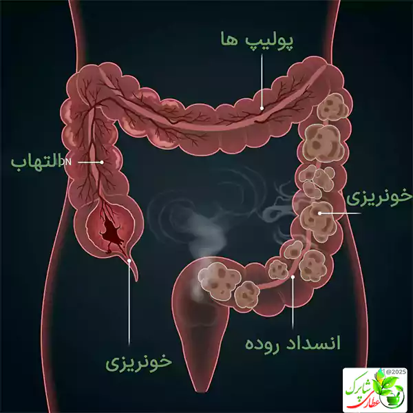 علائم سرطان روده اغلب در مراحل اولیه نامحسوس هستند، اما با پیشرفت بیماری، علائم قابل توجهی بروز می‌کنند.