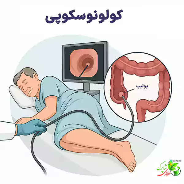 کولونوسکوپی چیست؟ این پرسش زمانی مطرح می‌شود که پزشک برای بررسی دقیق روده بزرگ چنین آزمایشی را تجویز می‌کند. کولونوسکوپی روشی تشخیصی است که به کمک آن می‌توان سطح داخلی روده بزرگ را با یک لوله باریک و انعطاف‌پذیر مجهز به دوربین مشاهده کرد