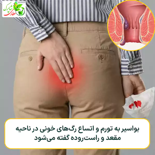 بواسیر به تورم و اتساع رگهای خونی در ناحیه مقعد و راستروده گفته میشود